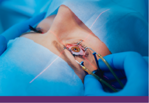 Laser μυωπίας: Ενδείξεις & διαδικασία