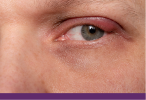 Χαλάζιο: Αιτία, συμπτώματα & θεραπεία