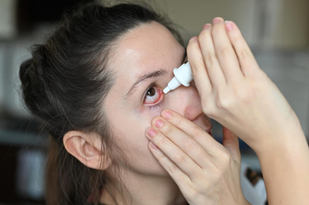 αλλεργική επιπεφυκίτιδα